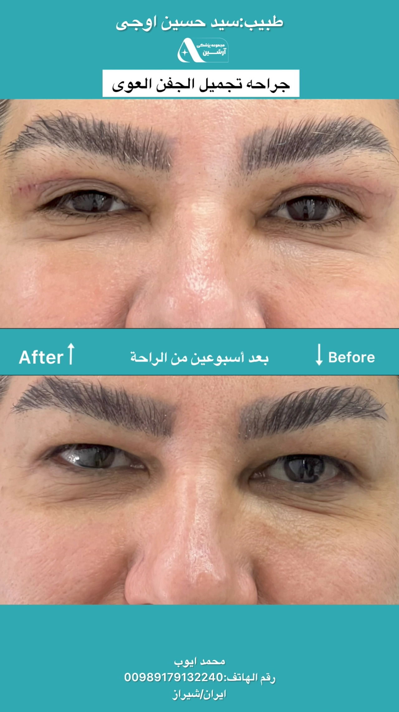 جراحی پلک